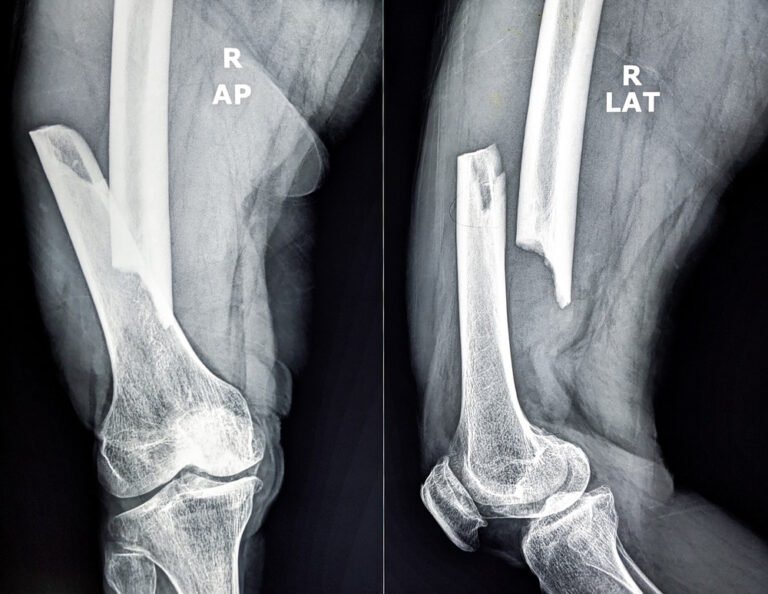 worst broken bones